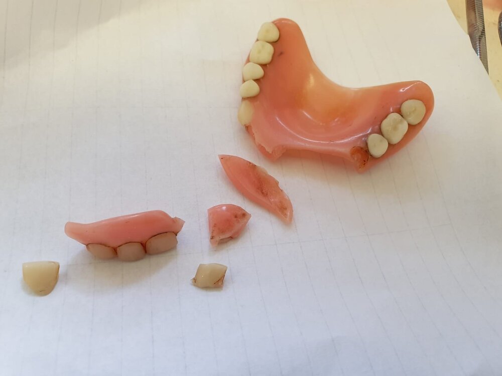 Same day denture repairs